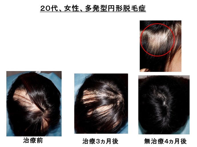 円形脱毛症　病院